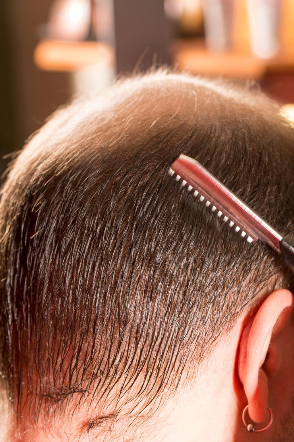 Why Hair Loss Is Becoming More Common and What You Can Do About It