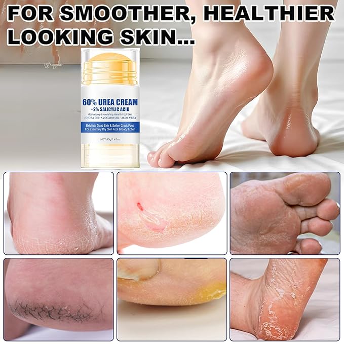60% Urea Foot Cream Care Stick for Feet Plus 2% Salicylic Acid, 2026 New Urea Heel Stick Cream 60 Percent Foot Callus Remover Cream for Feet Maximum Strength, for Dry Cracked Heels, Hands, Knees
