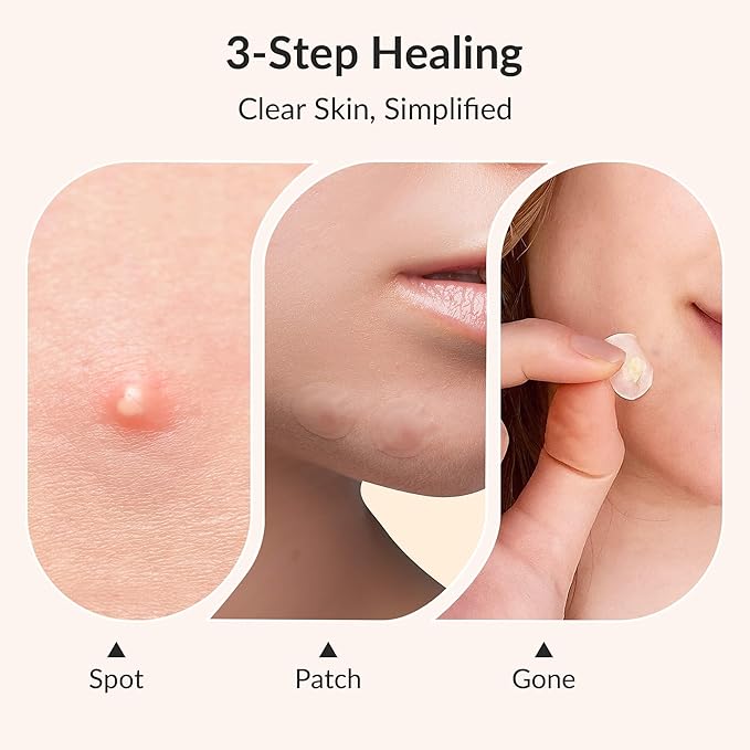 Invisible Pimple Patches – 4 Sizes Miracle Patches for Pimples with Hydrocolloid & Salicylic Acid, Korean Acne Patches for Face, Zit Stickers, Blemish Patches, Acne Spot Dots – 144 Count